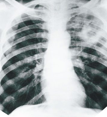 Alarma por el aumento de casos de tuberculosis